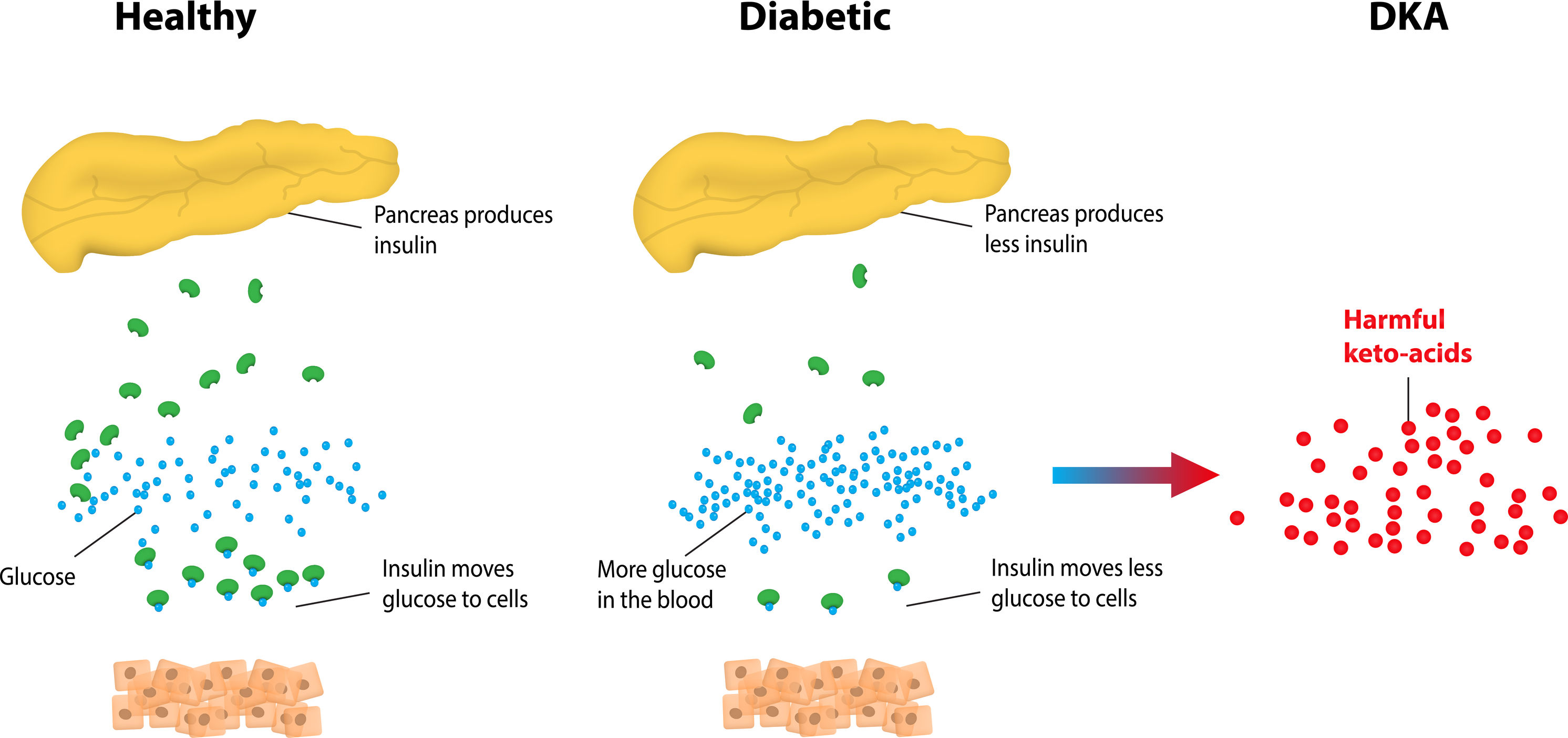 Ketoacidosis