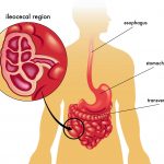 Neutropenic Enterocolitis