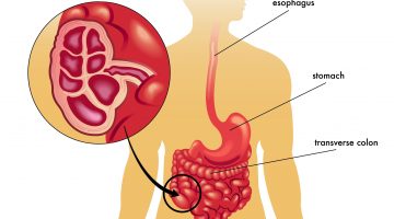 Neutropenic Enterocolitis