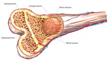 Paget’s Disease