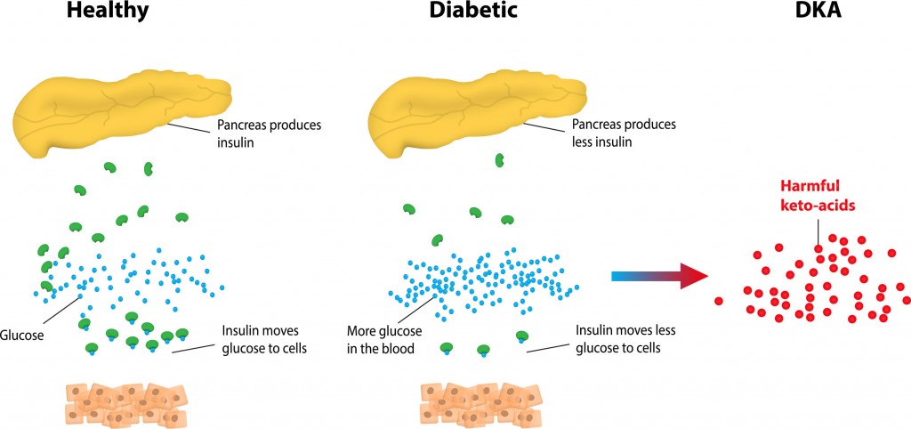 Diabetes mellitus (type 1, type 2) & diabetic ketoacidosis (DKA)