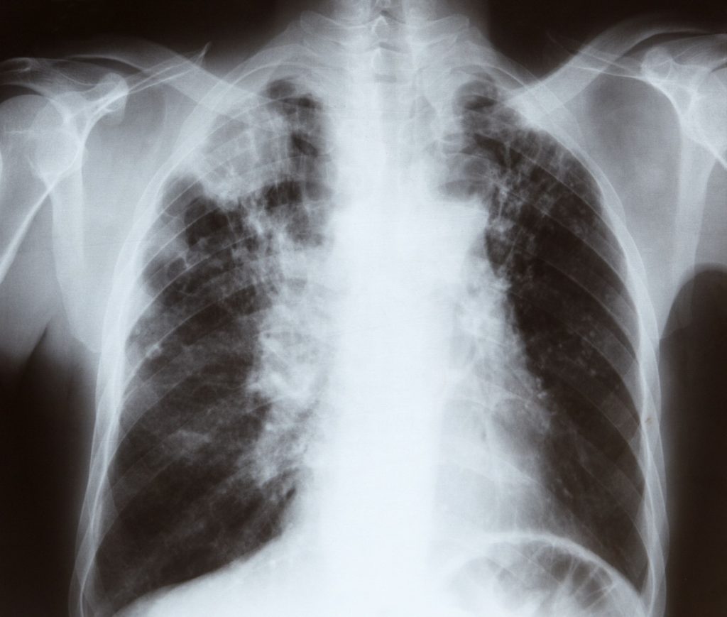 Рентген грудной клетки курильщика