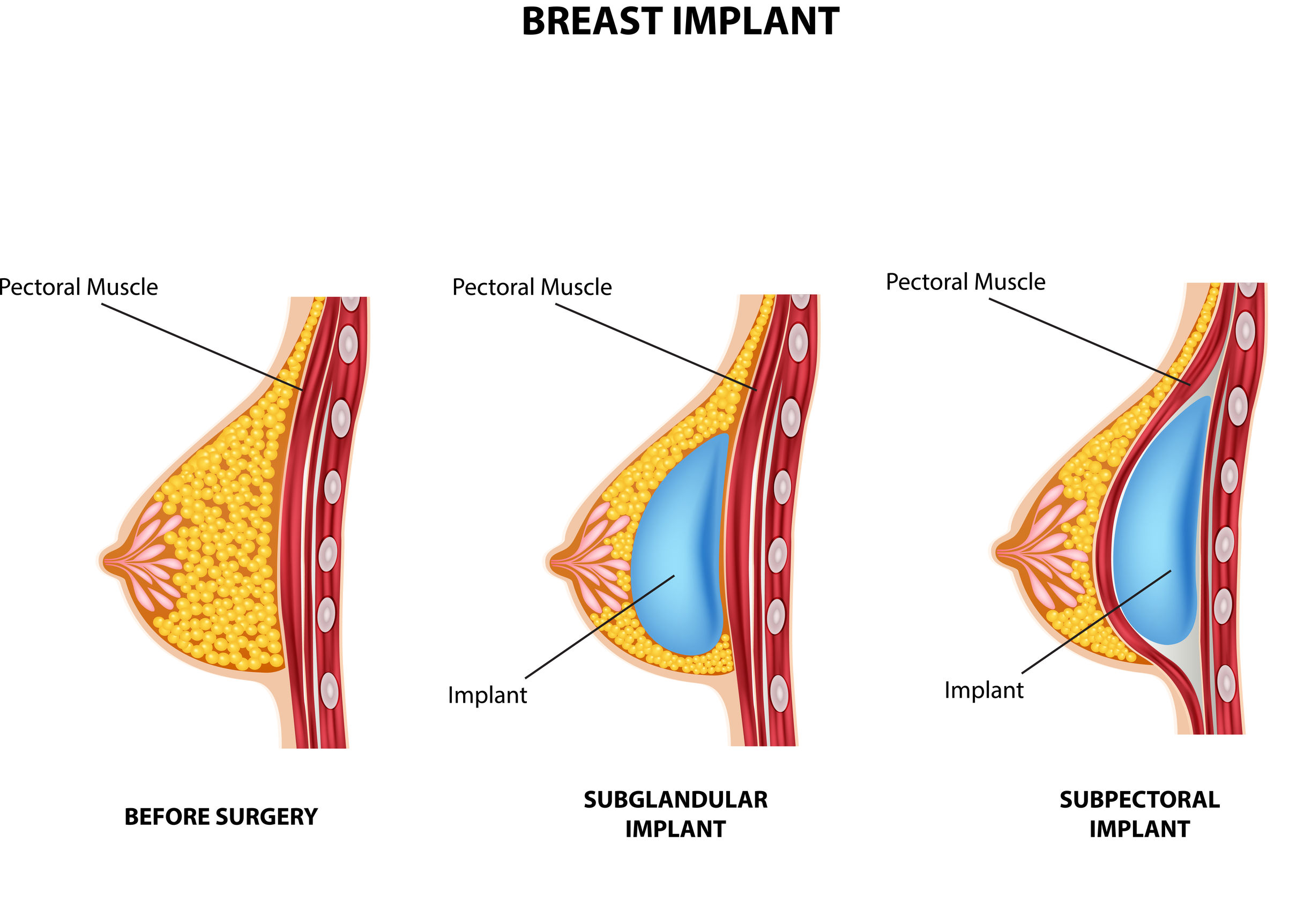 как лучше установить имплант груди фото 3