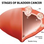 Bladder Cancer