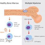 Blood Cancer