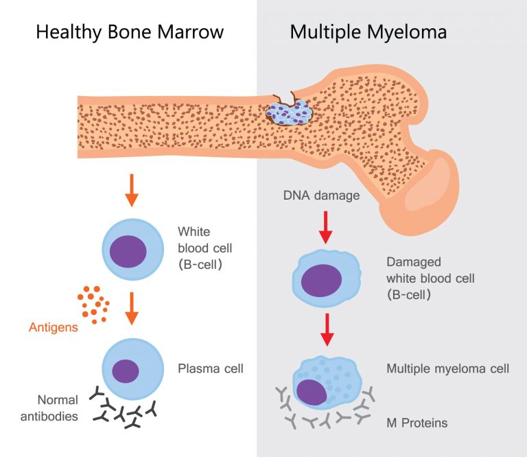 Multiple Myeloma