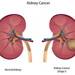 Kidney Cancer