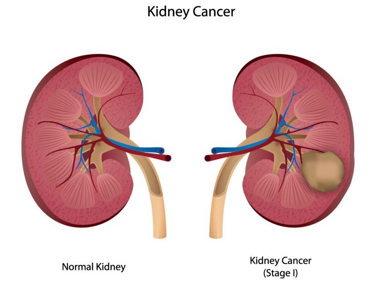 Kidney Cancer - DiseasesAndConditions.net