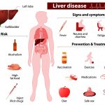 Liver Cancer