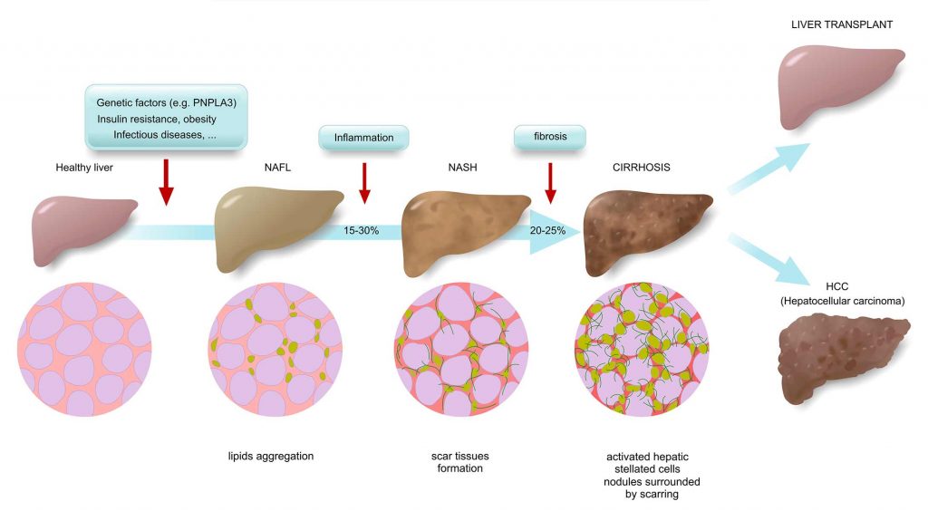 Nonalcoholic Fatty Liver Disease